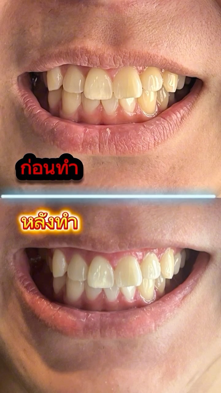 ✨初めてホワイトニング✨ @thailand.yuya 「めっちゃ白くなった」 「これで彼女ができる！」 そんな感想をいただきました☺️ 初めての方も安心してご来店ください♪ 今ならお得なキャンペーン実施中！ ✨ฟอกฟันขาวครั้งแรก ✨ “ฟันขาวขึ้นมากเลย!”...