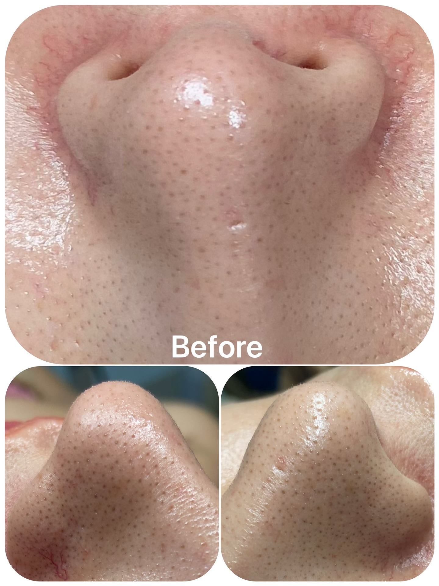 #エクストラクションtete式 #ベアハグバンコク#毛穴 #毛穴黒ずみ #blackhead 🍒本日のお客様🍒 ３０代　お子様と一緒にバンコク駐在中のワーキングママさん！　 まつ毛がなが〜くてキレイ❗️ 前回より、なかなか角栓が浮いてこず、、、 「クレンジングは何をお使いですか？？」 「毛穴に良いって人気のオイルクレンジングです」...