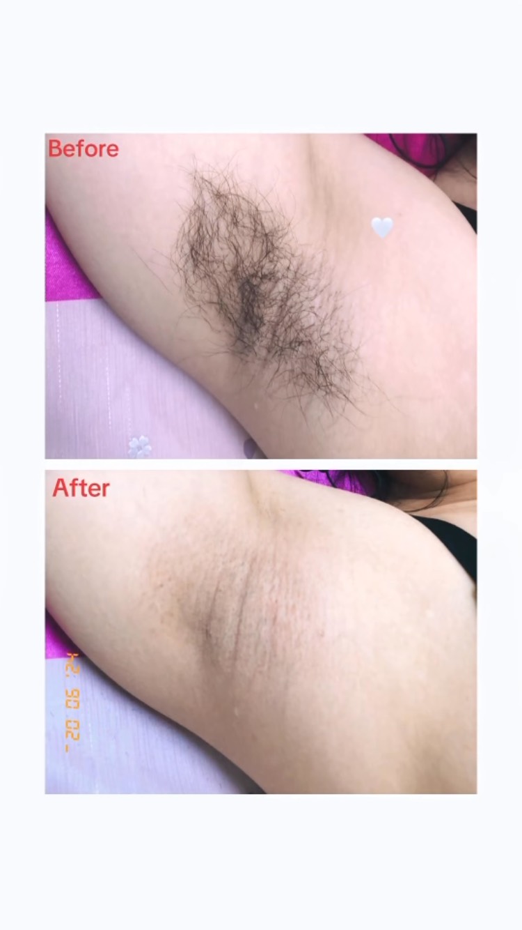 เลเซอร์ขนรักแร้เคลียร์ผิวเนียนใสในพริบตา! ดู Before & After กันชัดๆ ขนหาย ผิวเรียบขึ้น ทลายป่าดงดิบให้กลายเป็นผิวเรียบเนียน 10/10 ไม่หักค่ะ 🥰 #tokyobeauty #เลเซอร์ขนใกล้รถไฟฟ้า #เลเซอร์ขนรักแร้ #เลเซอร์ขนราคาถูก
